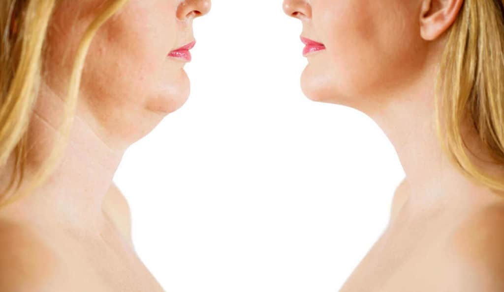 Double Chin treatment Fleet before and after results