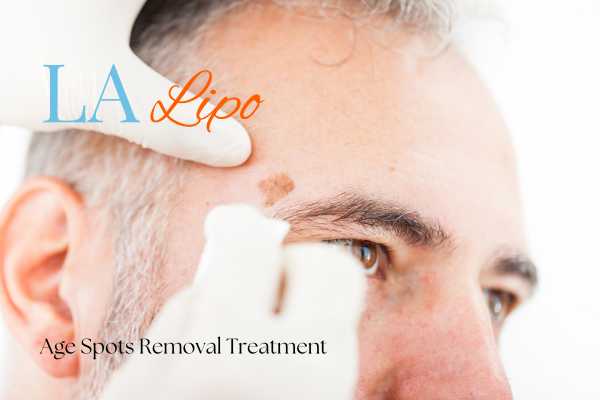 What Are the Most Effective Treatments for Age Spots Fleet?