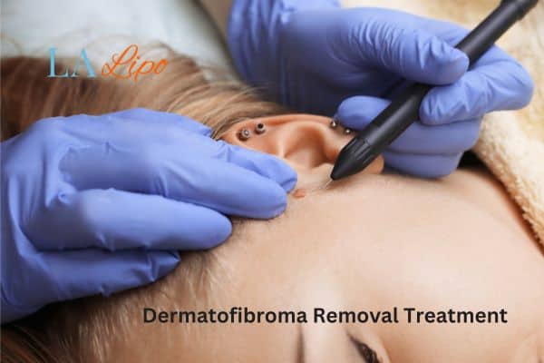 Dermatofibroma Removal Treatment Fleet