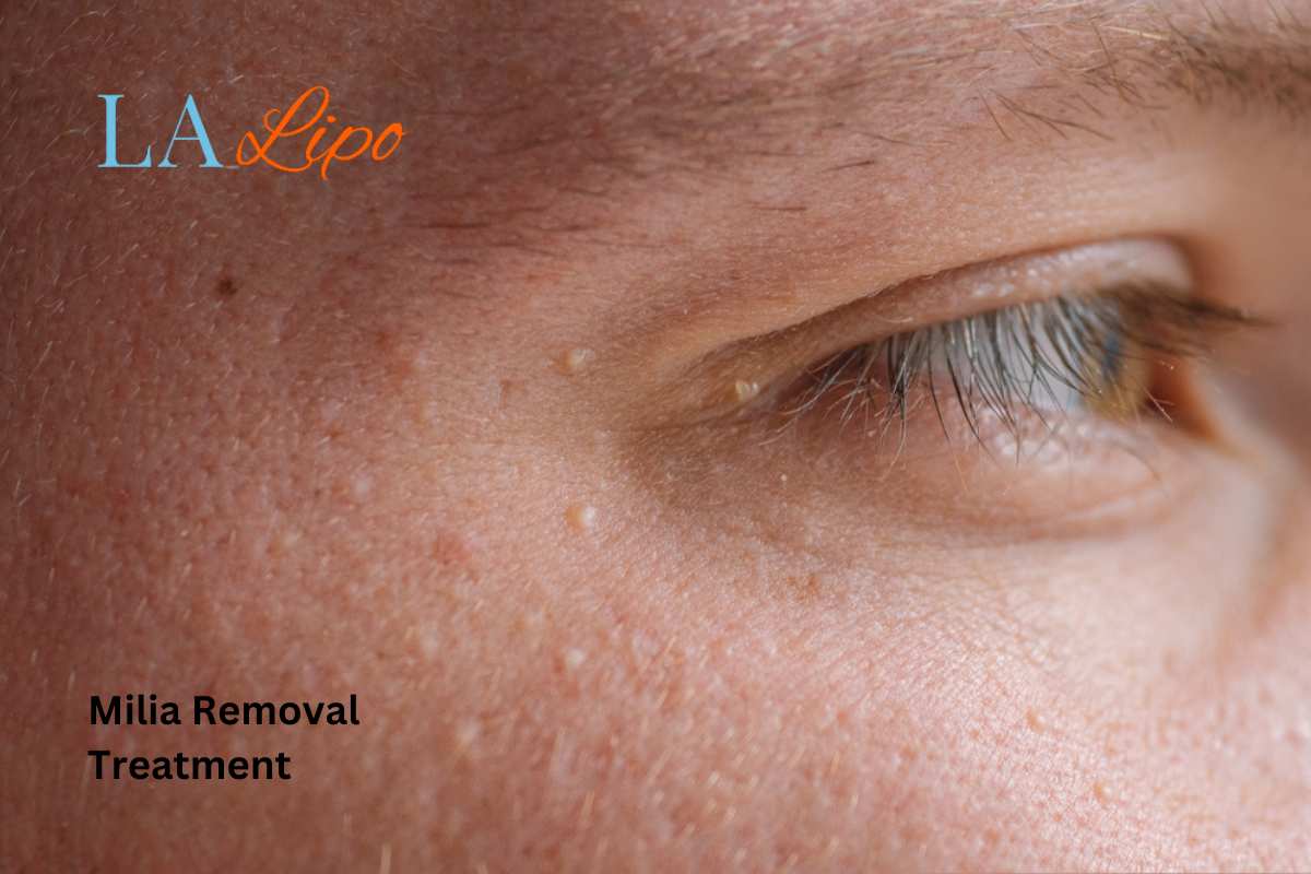Cryopen Milia Removal: Is It the Easiest and Safest Option Fleet?