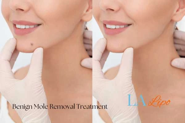 woman's before and after mole removal Fleet results