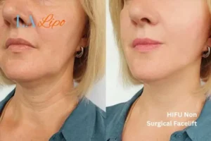 hi-fu for wrinkles Fleet before and after results