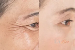 Before and after results of woman - HI-fu wrinkles reduction treatment Fleet