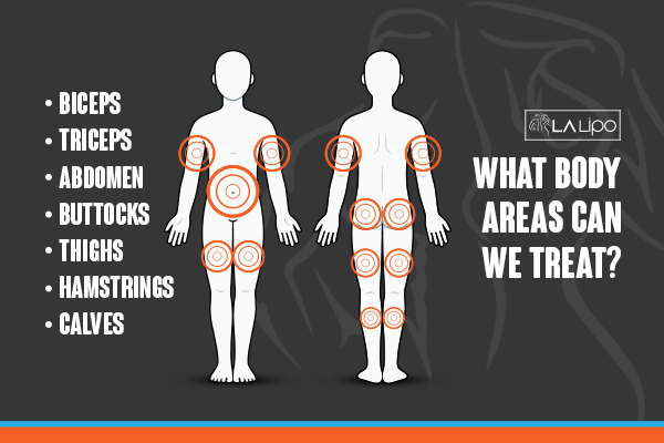 Graphic to show areas you can have LA-EMS Body Sculpting Fleet treatment.