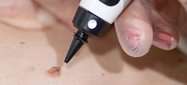 skin tag removal using cryopen Fleet