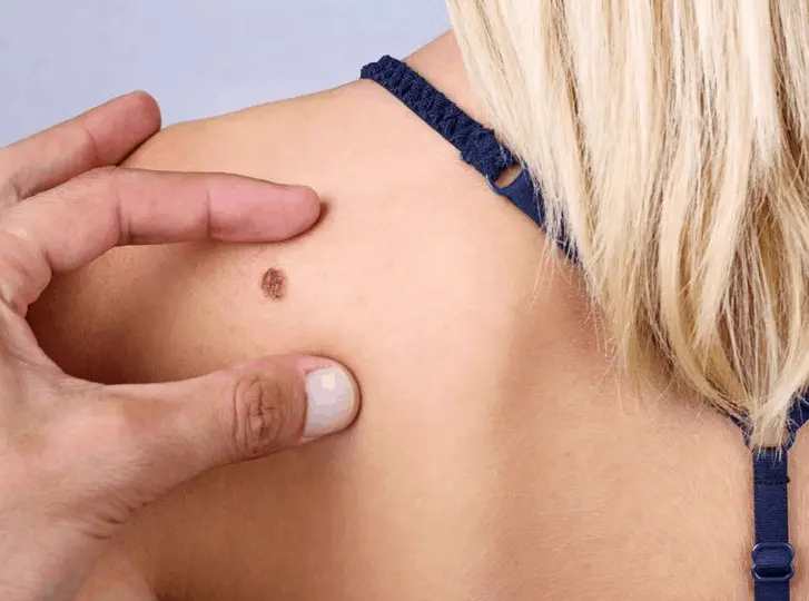 woman having mole removal Fleet consultation before treatment.
