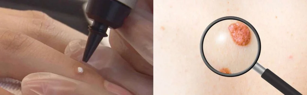 CryoPen practitioner Fleet assessing a benign mole before treatment