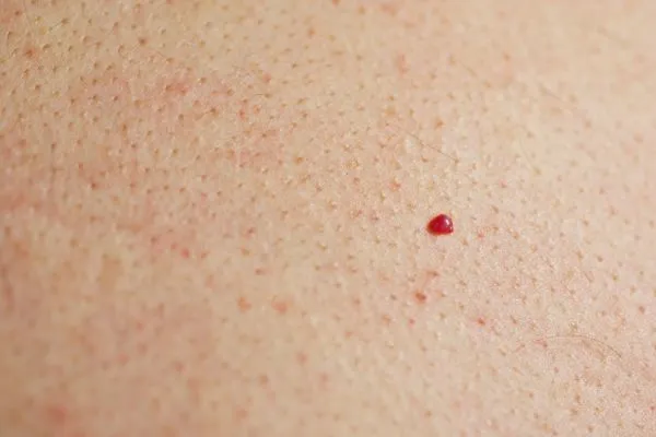 close up of a cherry angioma Fleet