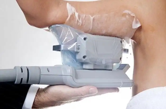 Picture of fat freezing Fleet on the upper arms.