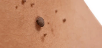 image of a skin tag Fleet