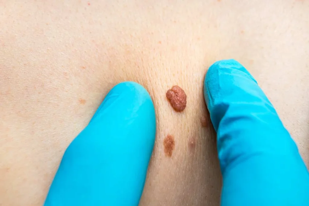 Consultant examining a skin tag Fleet