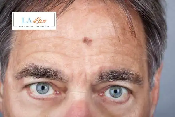 Solar Lentigo Removal Fleet image of man with mark on his forehead