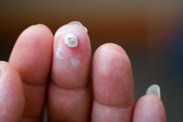 wart on person finger - cryotherapy to treat from LA LIPO Fleet