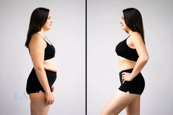 Picture of womans before and after using LA-EMS body sculpting to improve her core strength Fleet