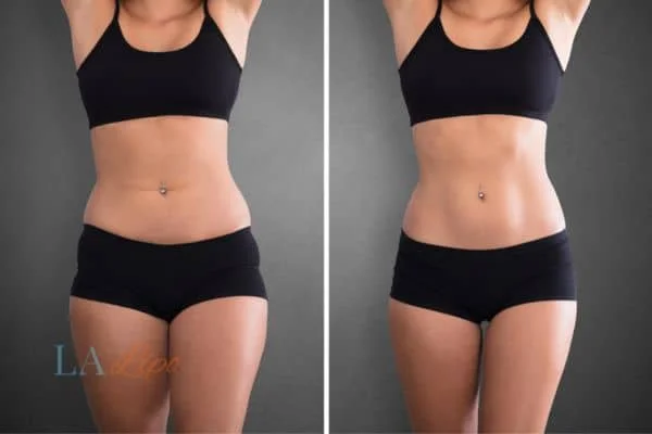 before and after results of non-surgical treatment to help a woman's body image and mental health Fleet