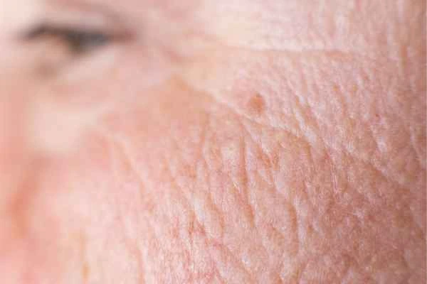 close up picture of a woman's face showing an age spot Fleet