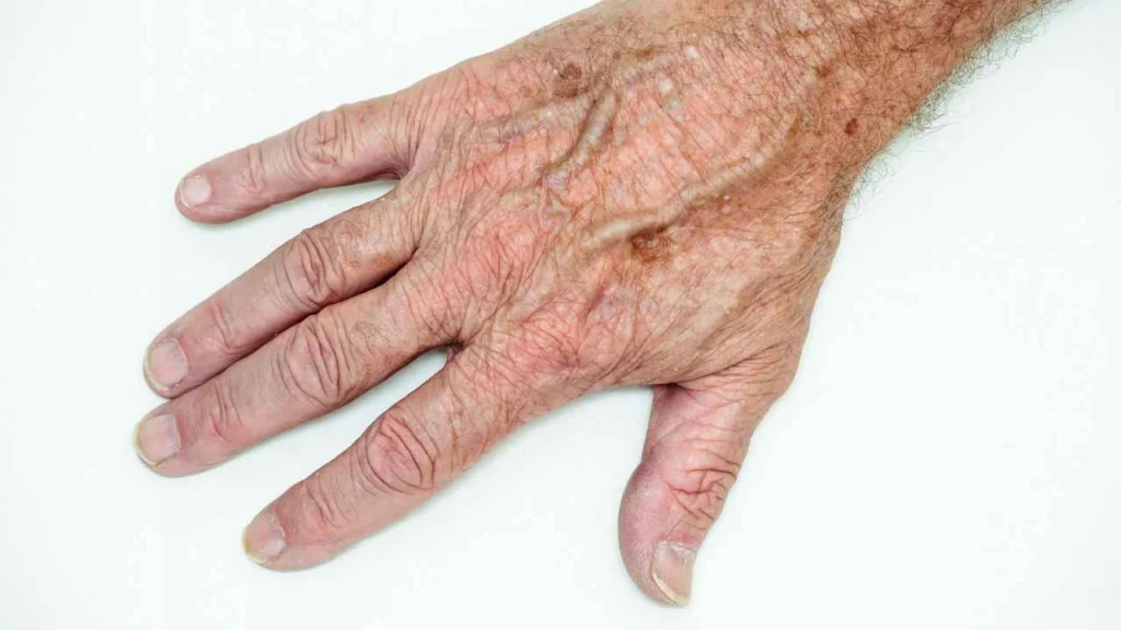 Male hand showing age spot Fleet