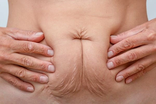 Should I Combine Diastasis Recti Treatment with Body Contouring for Better Results Fleet?
